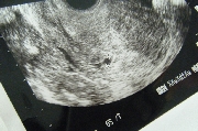 妊娠判明、エコー写真、妊娠5週目、基礎体温、排卵日、高温期、妊娠、可能性